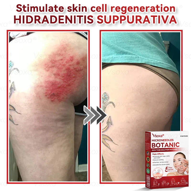 𝑉𝑠𝑜𝑥𝑎® 💧Microneedles Botanical Skin Tags Solution Patches - Made in the USA👩‍⚕️