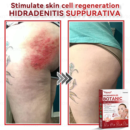 𝑉𝑠𝑜𝑥𝑎® 💧Microneedles Botanical Skin Tags Solution Patches - Made in the USA👩‍⚕️