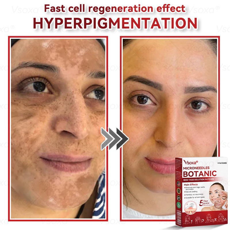 𝑉𝑠𝑜𝑥𝑎® 💧Microneedles Botanical Skin Tags Solution Patches - Made in the USA👩‍⚕️