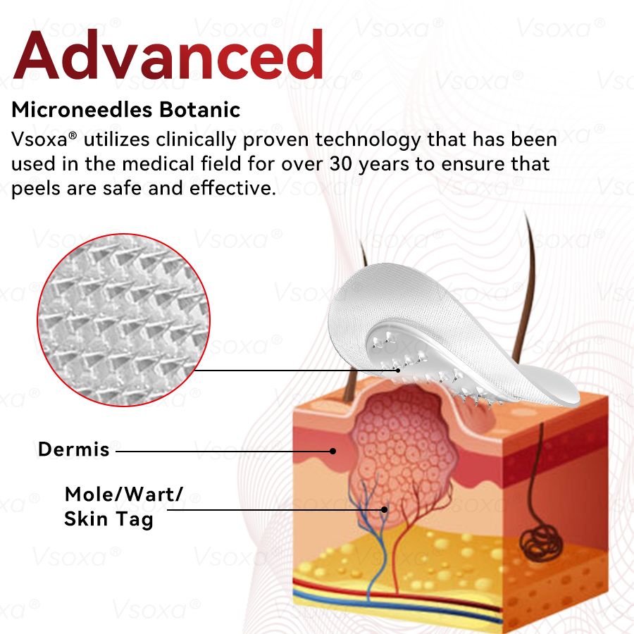 𝑉𝑠𝑜𝑥𝑎® 💧Microneedles Botanical Skin Tags Solution Patches - Made in the USA👩‍⚕️